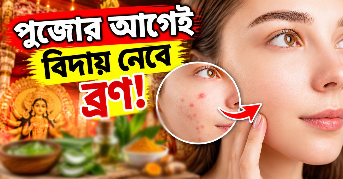 পুজোর আগেই বিদায় নেবে ব্রণ! এই ৪টি ভুল শুধরে নিলেই মুশকিল আসান